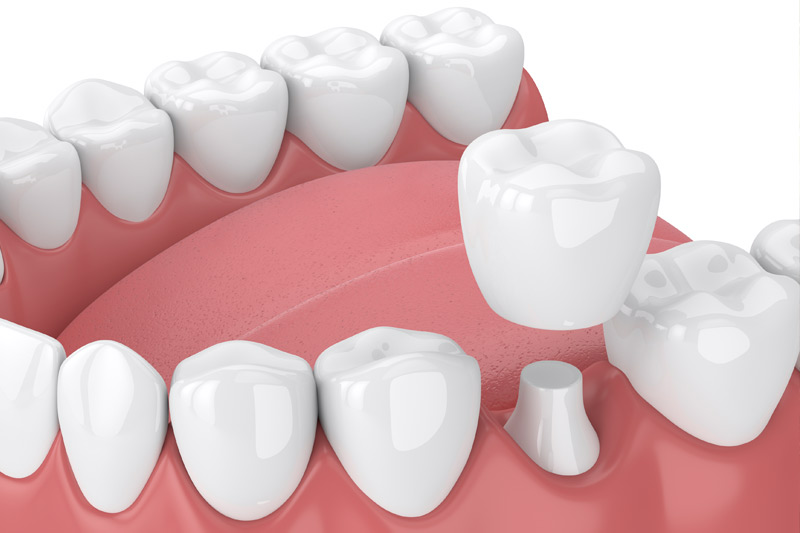 Dental Crowns in Strongsville