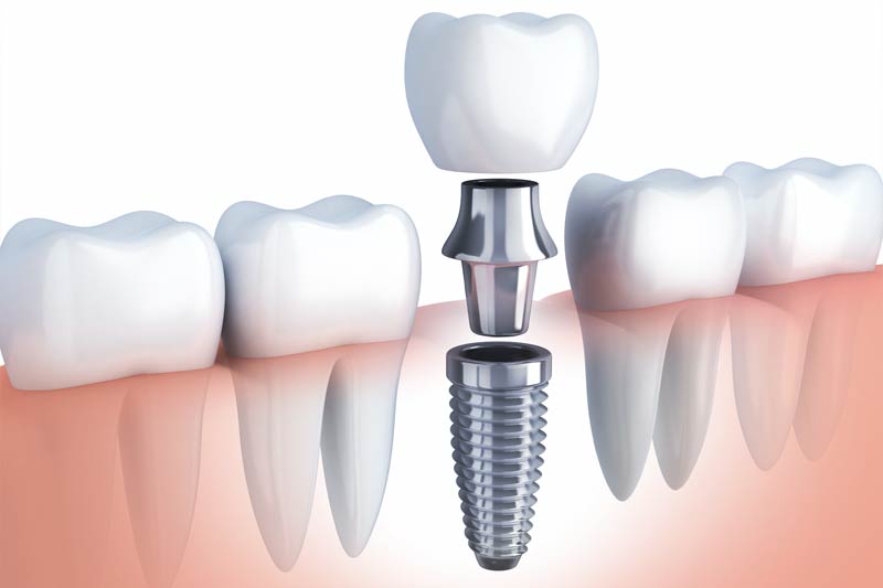 Implants Dentist in Strongsville