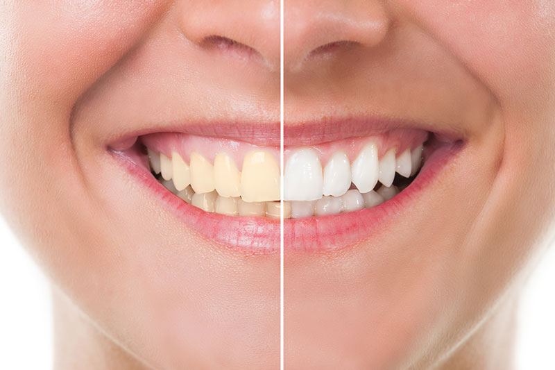 Teeth Whitening in Strongsville